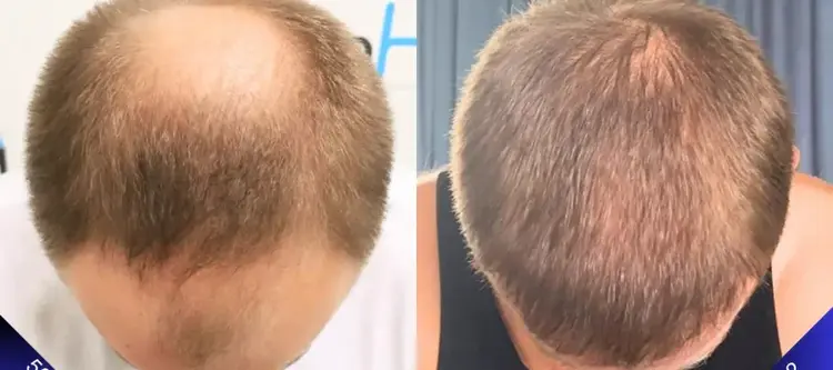 Greffe de cheveux de 5000 greffons