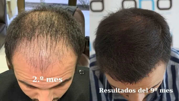 Fotografía que muestra el resultado de un trasplante de cabello a los 2 meses y a los 10 meses.