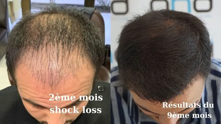 Photo montrant le résultat d'une greffe de cheveux après 2 mois et 10 mois