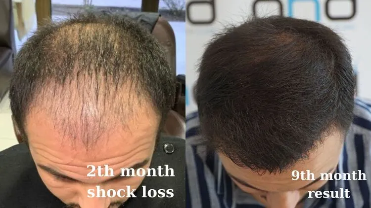 A photo showing 2 months of shock loss and the 10-month hair transplant results.