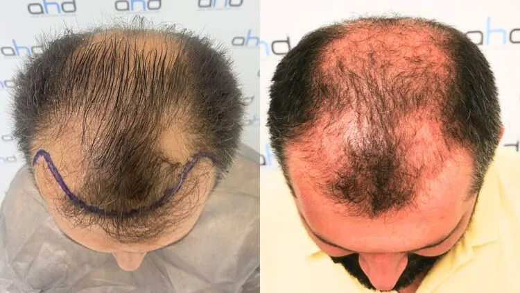 The 3-month image of a patient who experienced shock loss before and after the hair transplant.