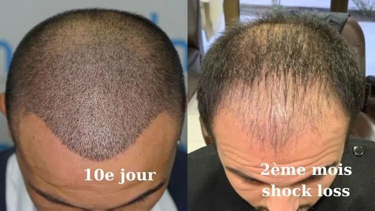 Perte permanente et mauvais aspect dus à une mauvaise collecte de greffons.