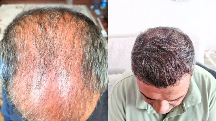 3 mois de chute de cheveux brutale et 1 an après