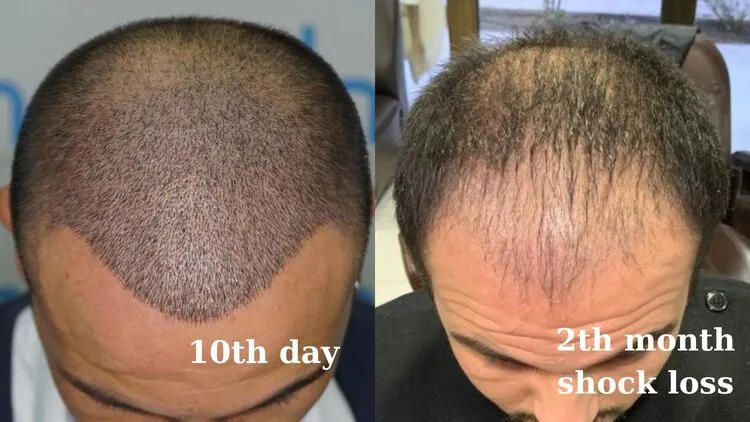 Fotoğu del trasplante de cabello de un hombre que muestra el shock de la caída a los 10 días y 2 meses