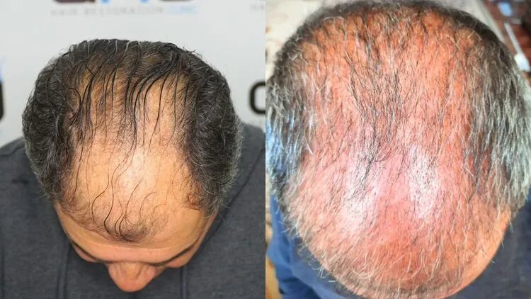 Pérdida de cabello por shock durante 3 meses