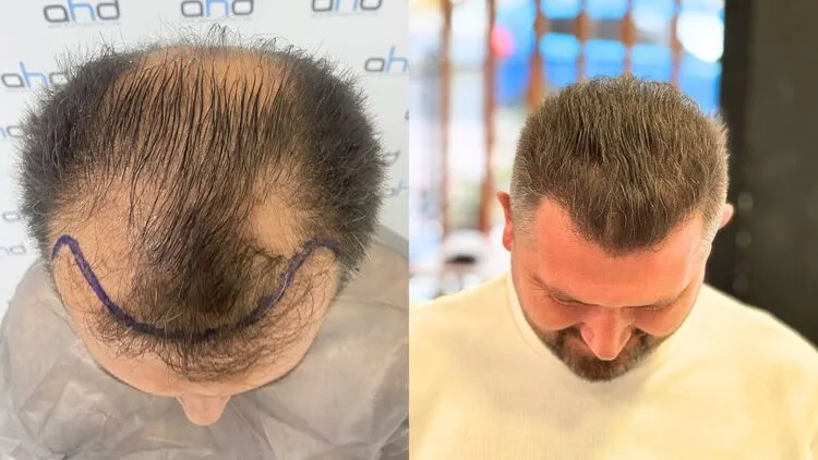 Image du patient à 3 mois avant la greffe de cheveux et pendant une période de chute de cheveux abondante.

