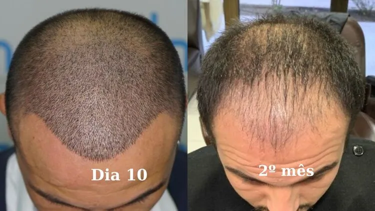 foto de um transplante capilar de um homem mostrando 10 dias e 2 meses de choque de queda

