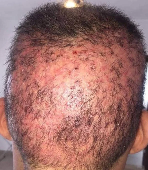 hatalı greft alımından dolayı oluşan kalıcı dökülme ve kötü görünüm