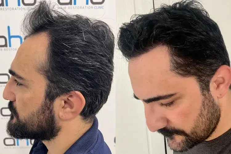 Vue du résultat d'une greffe de cheveux temporale, côté droit.