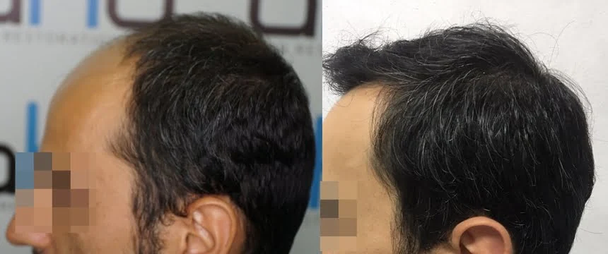 Haartransplantation an den Schläfen
