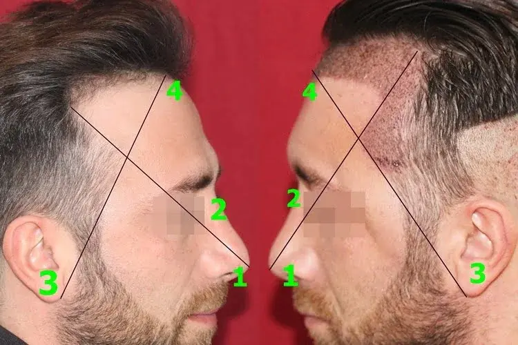 construção da linha de implantação do cabelo na têmpora e do triângulo temporal