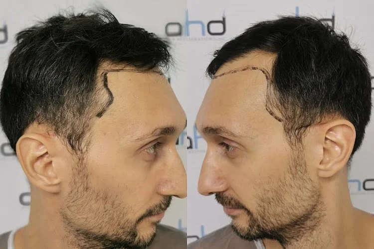 Implants capillaires pour les golfes temporaux