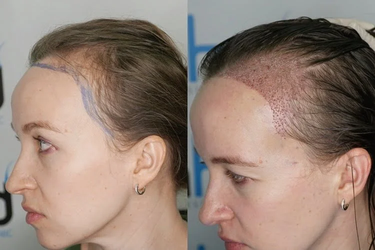 kadın şakak saç çizgisi tamamen tekli saç köklerinden oluşur.