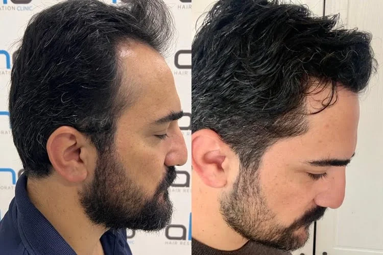 Résultat d'une greffe de 2500 greffons sur la ligne frontale et les tempes.