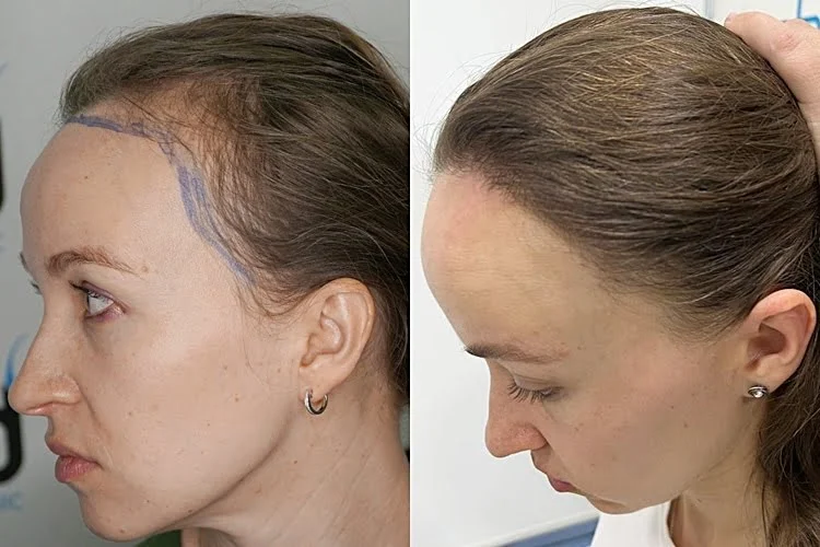 Het resultaat van een haartransplantatie uitgevoerd op de voorste haarlijn en slapen bij vrouwen.